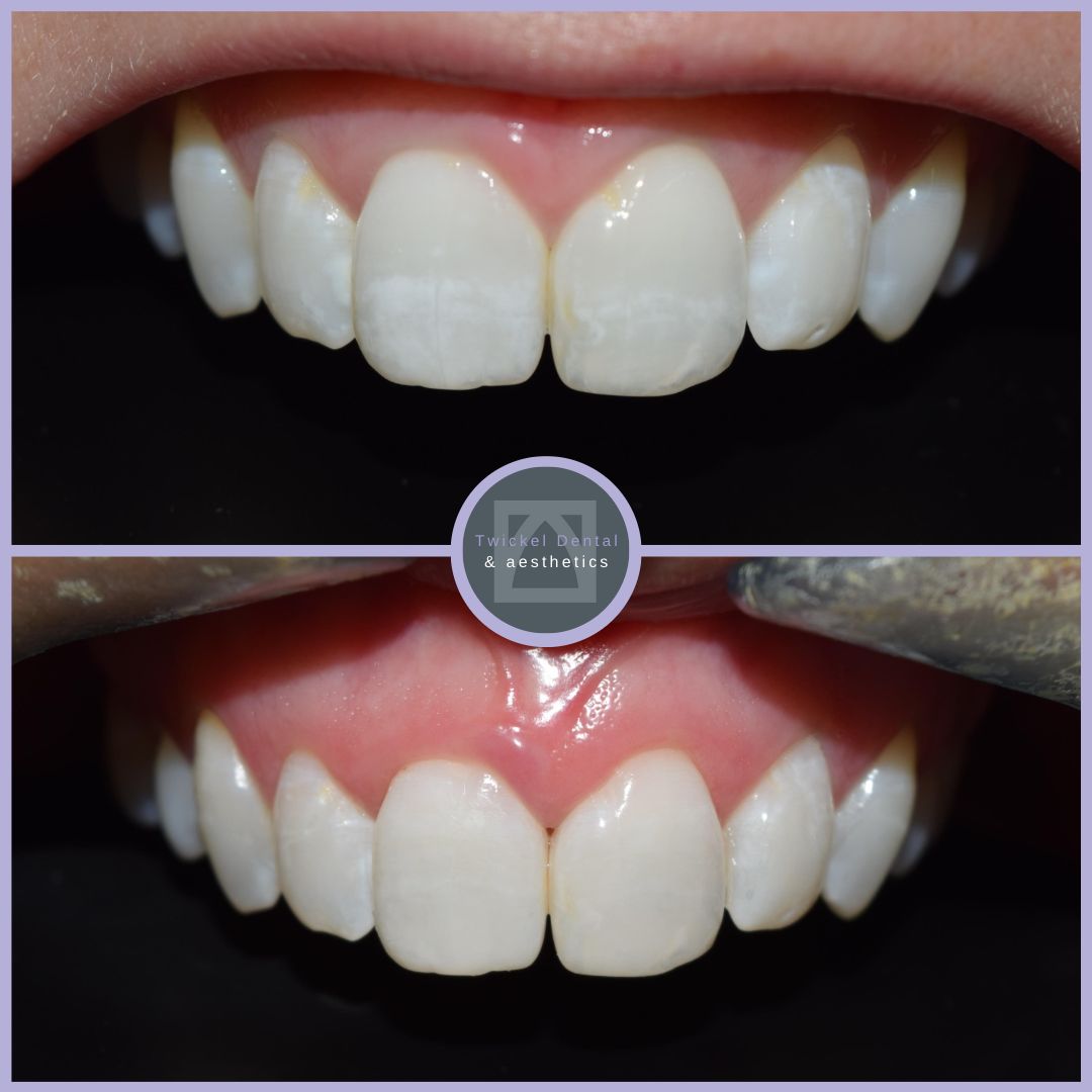 ICON Treatment Shropshire Before & After 1