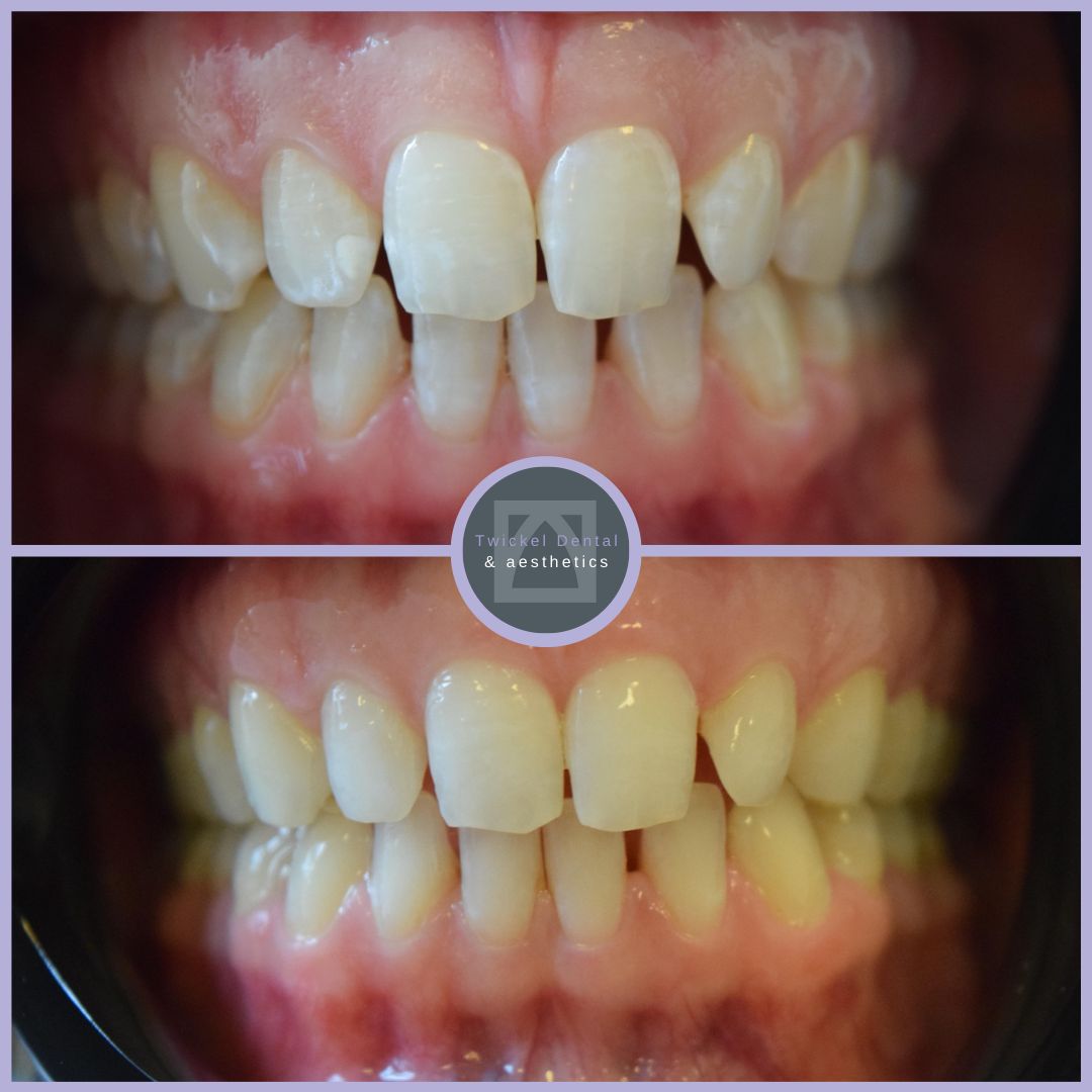 ICON Treatment Shropshire Before & After 2