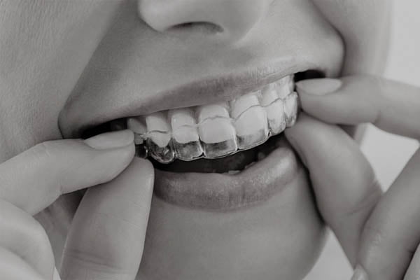 Invisalign telford
